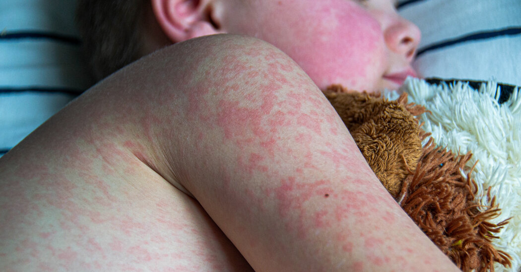 1,046 Measles Cases Reported In US; Indiana Outbreak Declared Over 1,046 Measles Cases Reported In US; Indiana Outbreak Declared Over
