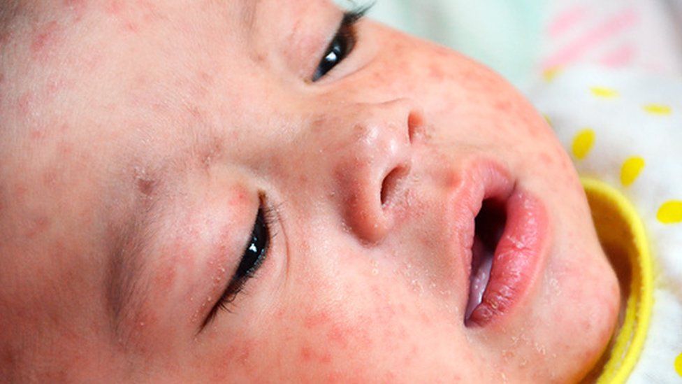 Addressing The Measles Crisis: New US Vaccine Monitoring Initiatives Addressing The Measles Crisis: New US Vaccine Monitoring Initiatives