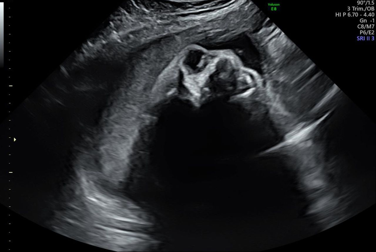 Bilateral Anophthalmia In Babies: Causes, Diagnosis, And Support For Families Bilateral Anophthalmia In Babies: Causes, Diagnosis, And Support For Families