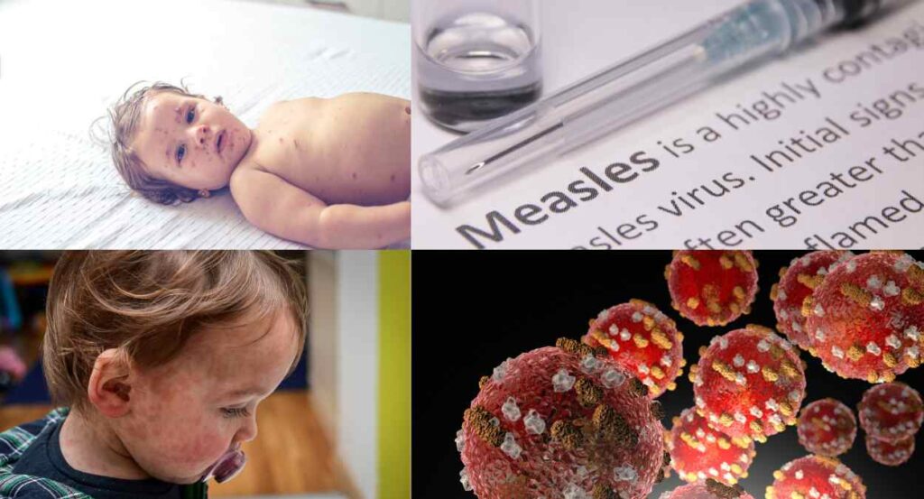 Combating The Persistence Of Measles: Challenges And Solutions Combating The Persistence Of Measles: Challenges And Solutions
