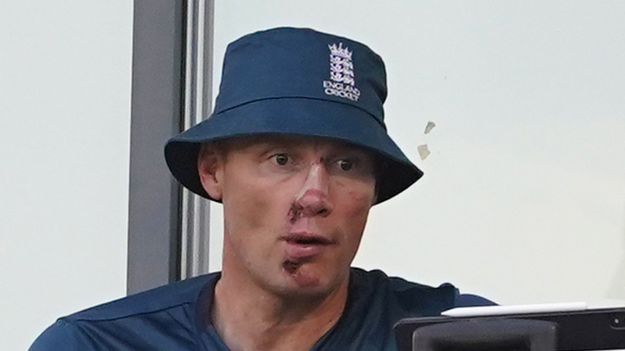 Freddie Flintoff Reveals Face After Top Gear Crash Injury Freddie Flintoff Reveals Face After Top Gear Crash Injury