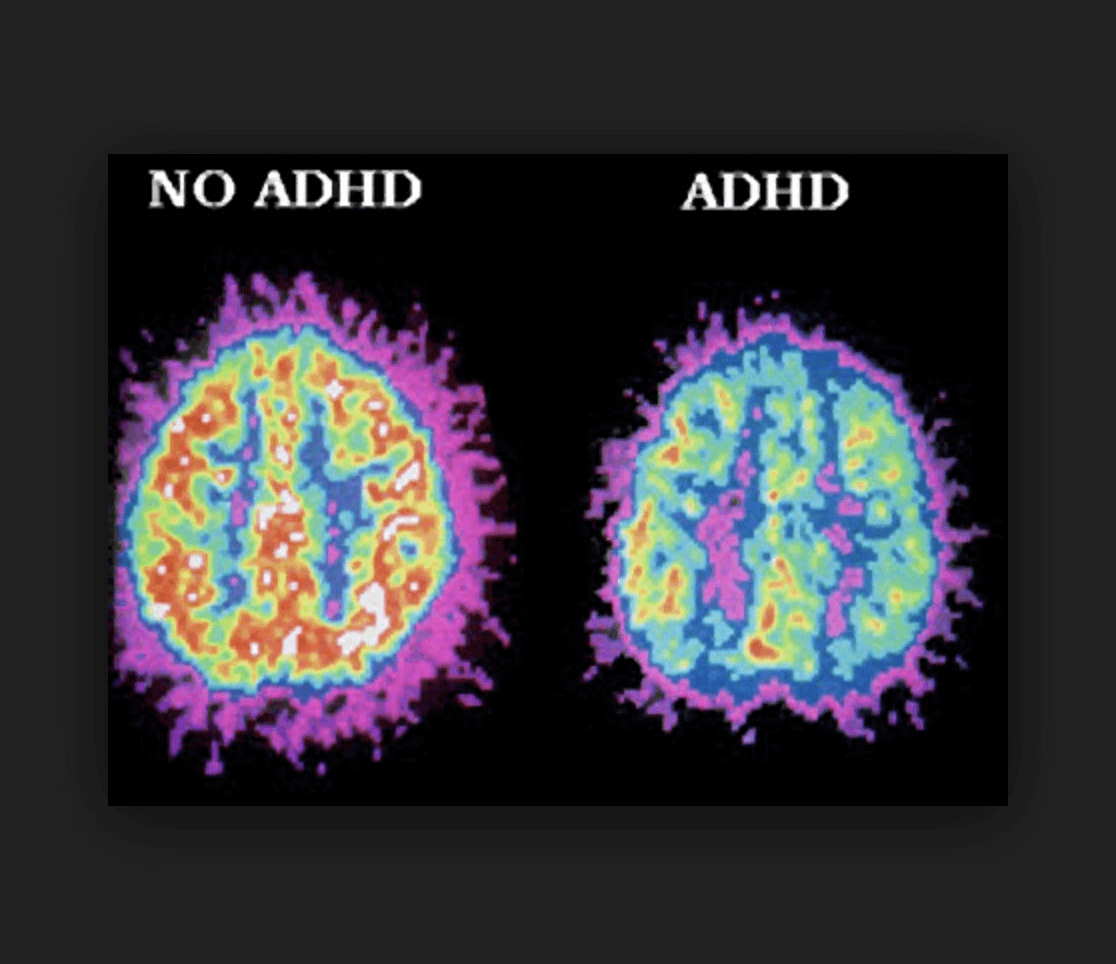 Inside Our ADHD Minds: Understanding The ADHD Brain Inside Our ADHD Minds: Understanding The ADHD Brain