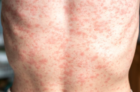 Kansas Faces Measles Resurgence: Causes And Prevention Kansas Faces Measles Resurgence: Causes And Prevention
