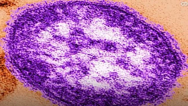 Measles Outbreak In Kansas: A Growing Concern Measles Outbreak In Kansas: A Growing Concern