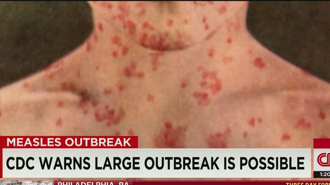 Recent Measles Cases In Texas: A Look At The Unlinked Outbreaks Recent Measles Cases In Texas: A Look At The Unlinked Outbreaks