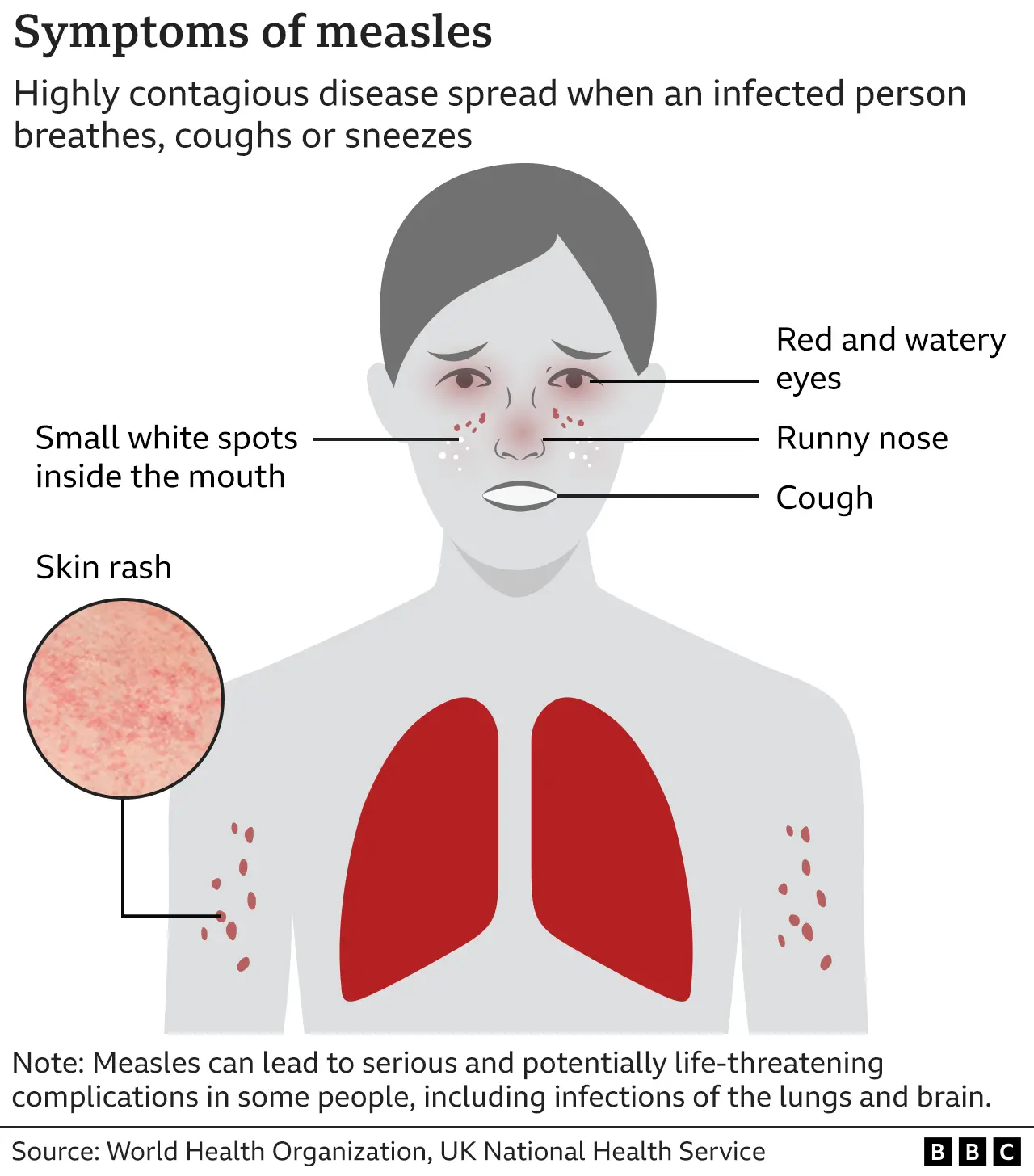 Six More Measles Cases Confirmed In Kansas: Public Health Officials Issue Warning Six More Measles Cases Confirmed In Kansas: Public Health Officials Issue Warning