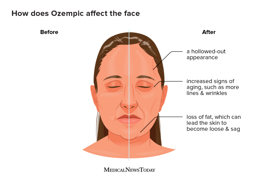 The FDA's Action Against Off-Brand Ozempic: Concerns About Access The FDA's Action Against Off-Brand Ozempic: Concerns About Access