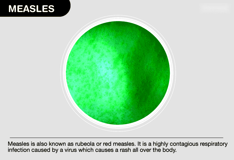 The Persistence Of Measles: Understanding Continued Transmission The Persistence Of Measles: Understanding Continued Transmission