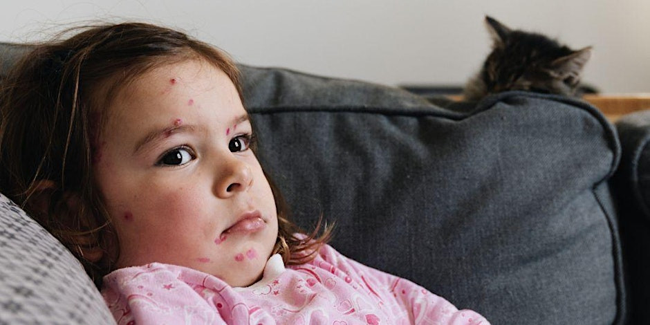 Understanding Virginia's Second Measles Case In 2025 Understanding Virginia's Second Measles Case In 2025