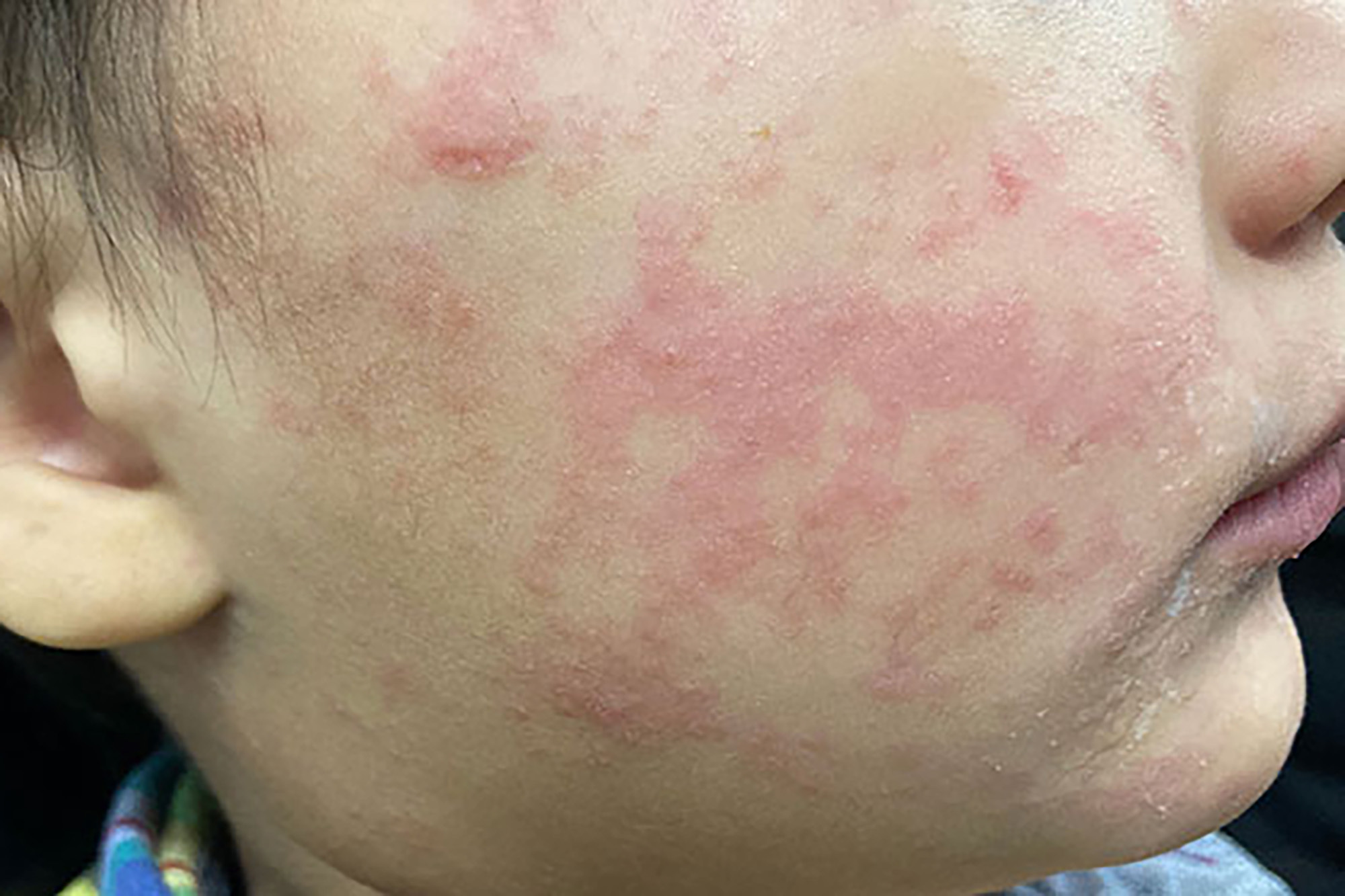 Update: 1,046 Measles Cases Confirmed In The US, Indiana Outbreak Resolved Update: 1,046 Measles Cases Confirmed In The US, Indiana Outbreak Resolved